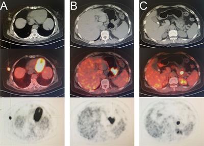 Case Report: Next-Generation Sequencing-Based Detection in A Patient with Three Synchronous Primary Tumors